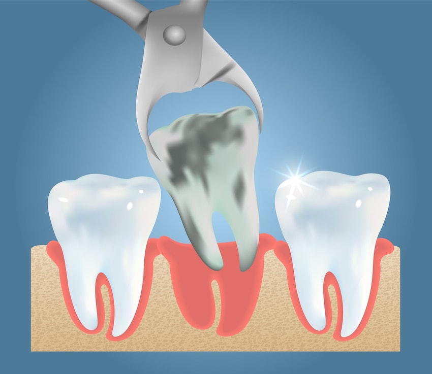 Illustration of a rotten tooth being pulled from a gum line