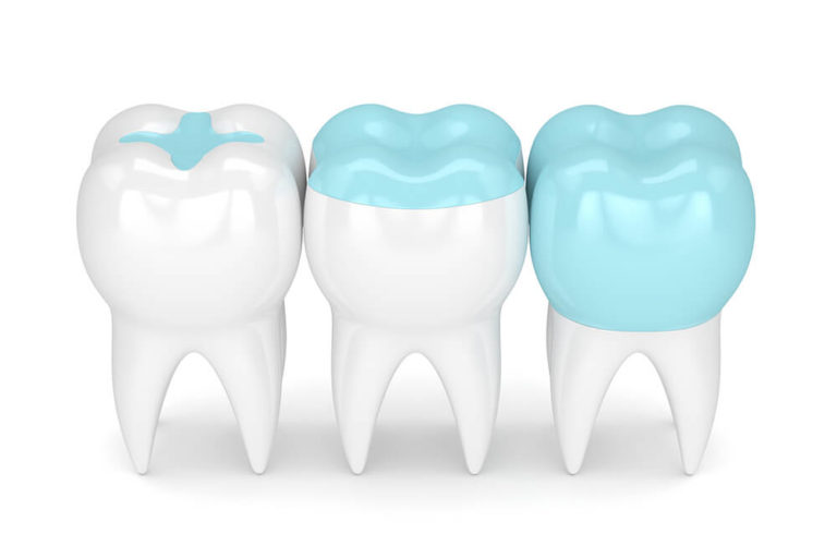 illustration of the different stages of having a dental sealant applied to a tooth