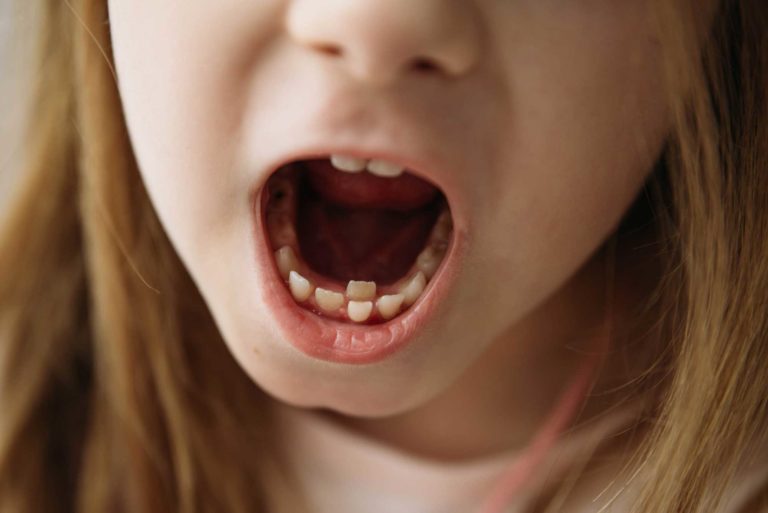 a child who has their adult teeth growing behind baby teeth