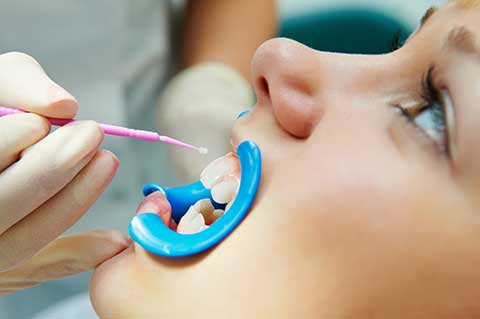 pediatric dental patient receiving a dental sealant on their teeth