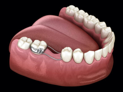 illustration of a space maintaining appliance